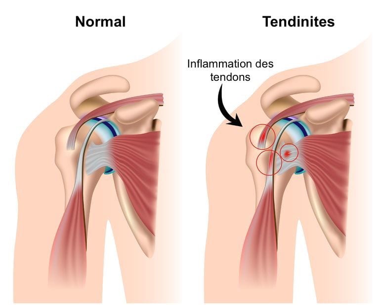 7 astuces naturelles pour soigner une tendinite 1