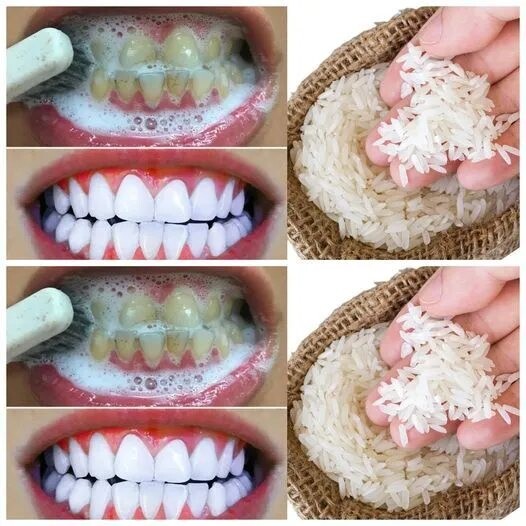 Blanchiment des Dents Rapide : Souriez avec Éclat en un Instant ! 1