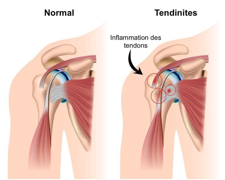 7 astuces naturelles pour soigner une tendinite 1 7 astuces naturelles pour soigner une tendinite 1