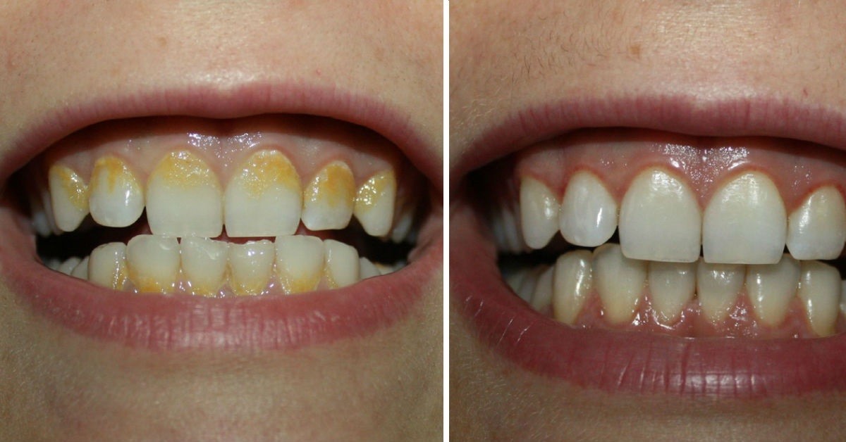 4 Astuces de grand mère pour enlever le tartre des dents 1 4 Astuces de grand mère pour enlever le tartre des dents 1