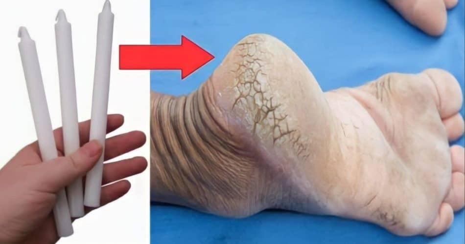 Talons fissurés ? Dites adieu aux crevasses avec l'astuce de la bougie ! 1