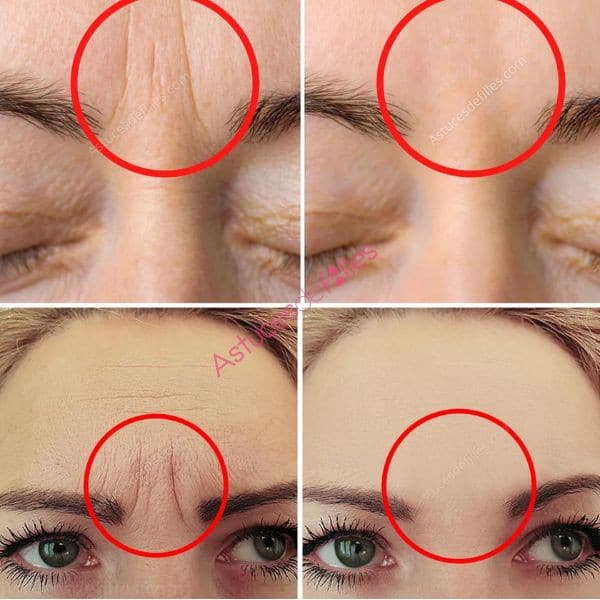 Réduction des Rides Entre les Sourcils: Transformez Votre Visage en Œuvre d'Art! 1 Réduction des Rides Entre les Sourcils: Transformez Votre Visage en Œuvre d'Art! 1