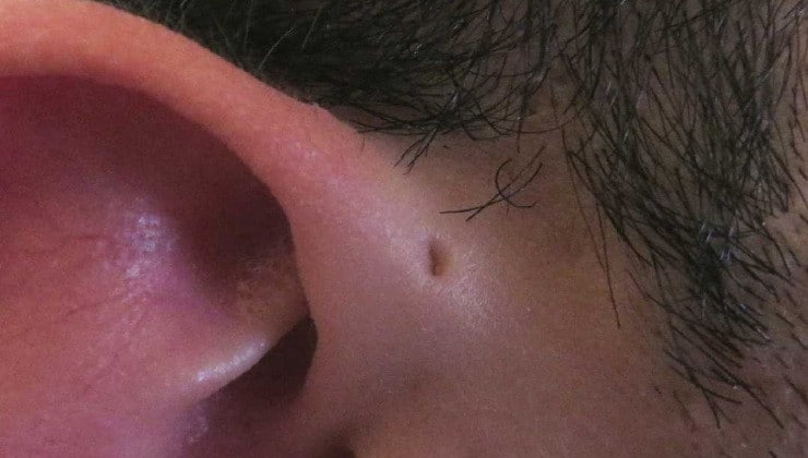 Sinus Pré-Auriculaires: Découvrez le Mystère du Petit Trou d'Oreille! 2