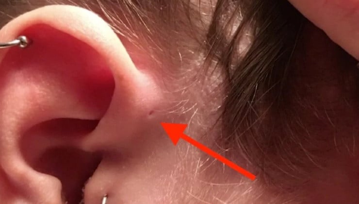 Sinus Pré-Auriculaires: Découvrez le Mystère du Petit Trou d'Oreille! 3