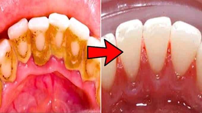 4 Astuces de Dentiste Pour Enlever le Tartre Dentaire Soi-Même. 1 4 Astuces de Dentiste Pour Enlever le Tartre Dentaire Soi-Même. 1