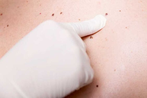 Les grains de beauté : Pourquoi apparaissent-ils et que peuvent-ils nous dire sur notre santé ? 1 Les grains de beauté : Pourquoi apparaissent-ils et que peuvent-ils nous dire sur notre santé ? 1