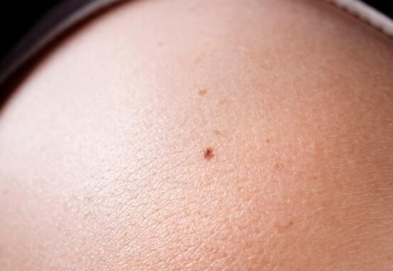 Les grains de beauté : Pourquoi apparaissent-ils et que peuvent-ils nous dire sur notre santé ? 2 Les grains de beauté : Pourquoi apparaissent-ils et que peuvent-ils nous dire sur notre santé ? 2